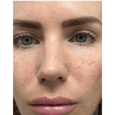 PRX DERM PERFEXION Before & After Gallery - Patient 490413 - Image 1