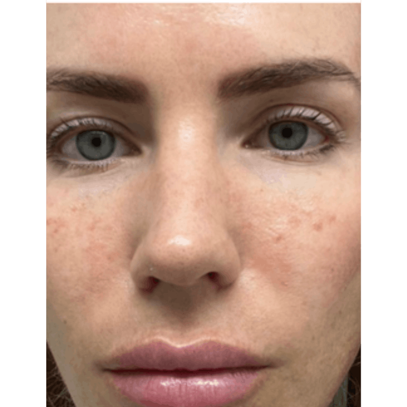 PRX DERM PERFEXION Before & After Gallery - Patient 490413 - Image 1