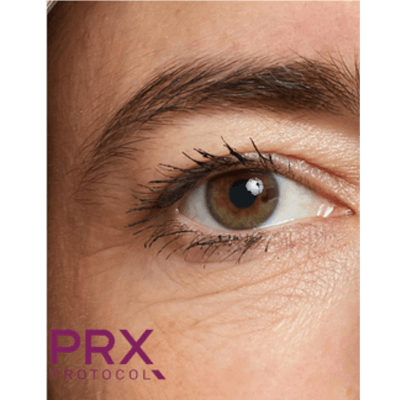 PRX DERM PERFEXION Before & After Gallery - Patient 164151 - Image 1