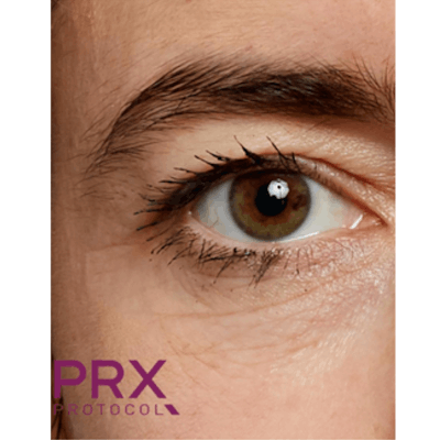 PRX DERM PERFEXION Before & After Gallery - Patient 164151 - Image 2