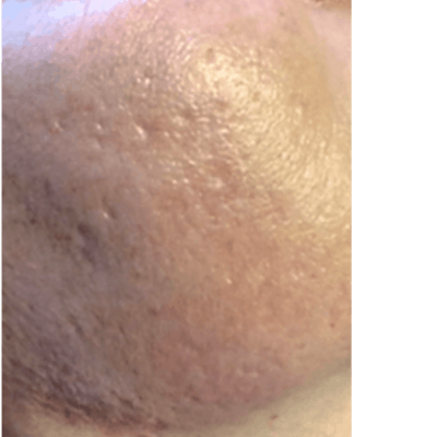 PRX DERM PERFEXION Before & After Gallery - Patient 413512 - Image 1