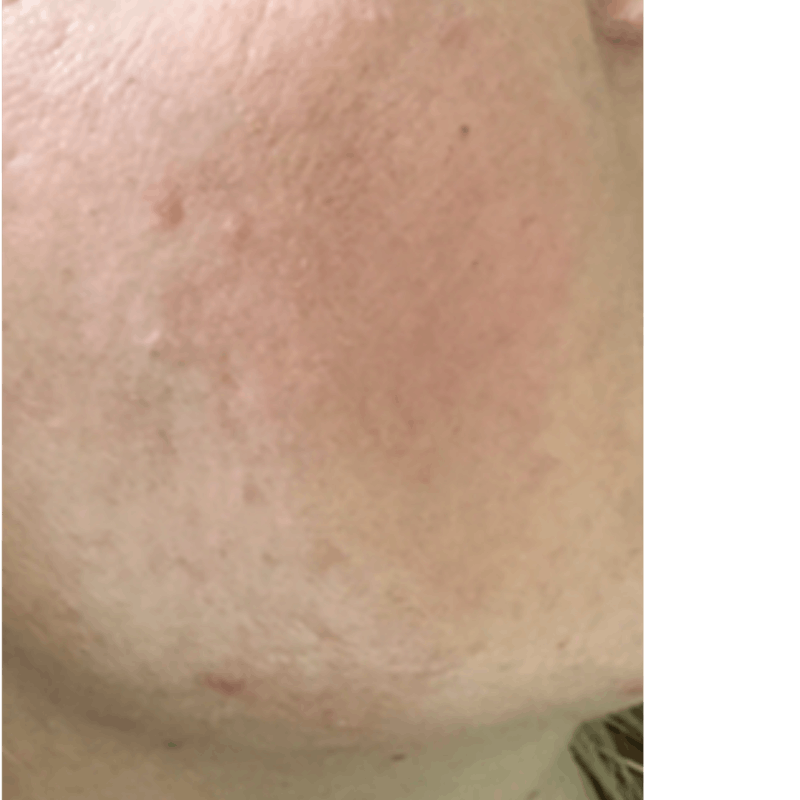 PRX DERM PERFEXION Before & After Gallery - Patient 413512 - Image 2