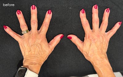 Radiesse Before & After Gallery - Patient 177739 - Image 1