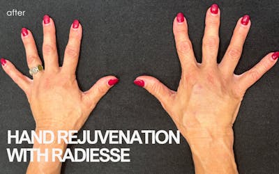 Radiesse Before & After Gallery - Patient 177739 - Image 2