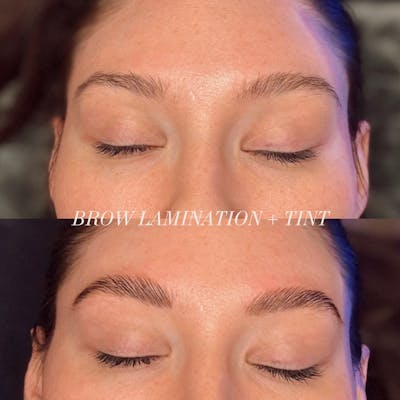 Brows Before & After Gallery - Patient 750641 - Image 1
