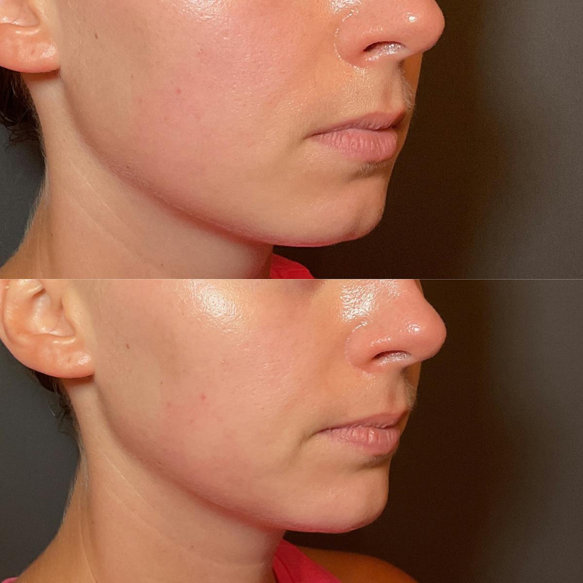 Filler Before & After Gallery - Patient 406387 - Image 1