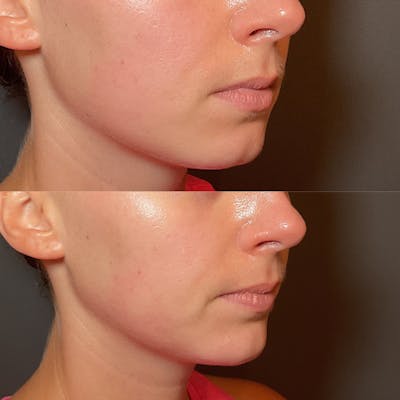 Filler Before & After Gallery - Patient 406387 - Image 1