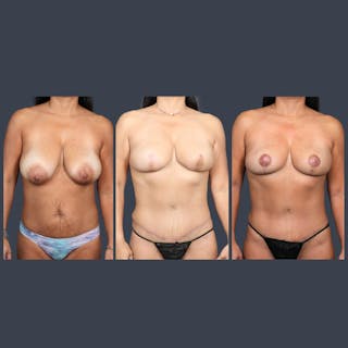 DIEP Flap Before & After Gallery - Patient 129174 - Image 6