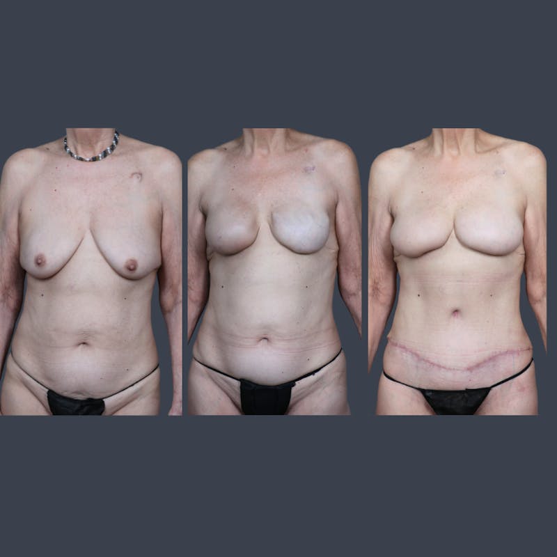 DIEP Flap Before & After Gallery - Patient 330453 - Image 6