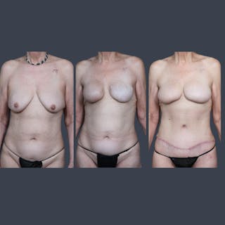 DIEP Flap Before & After Gallery - Patient 330453 - Image 6