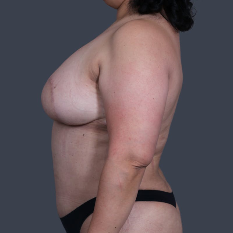 DIEP Flap Before & After Gallery - Patient 202049 - Image 4
