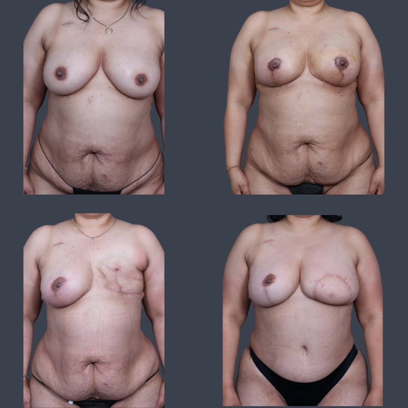 DIEP Flap Before & After Gallery - Patient 202049 - Image 5