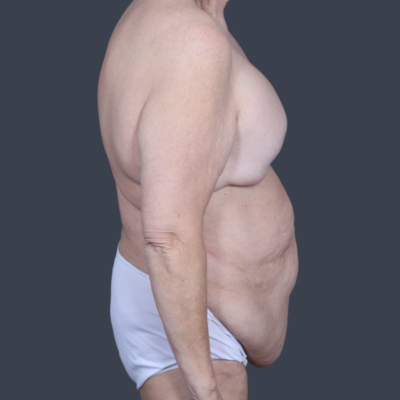 DIEP Flap Before & After Gallery - Patient 269118 - Image 3