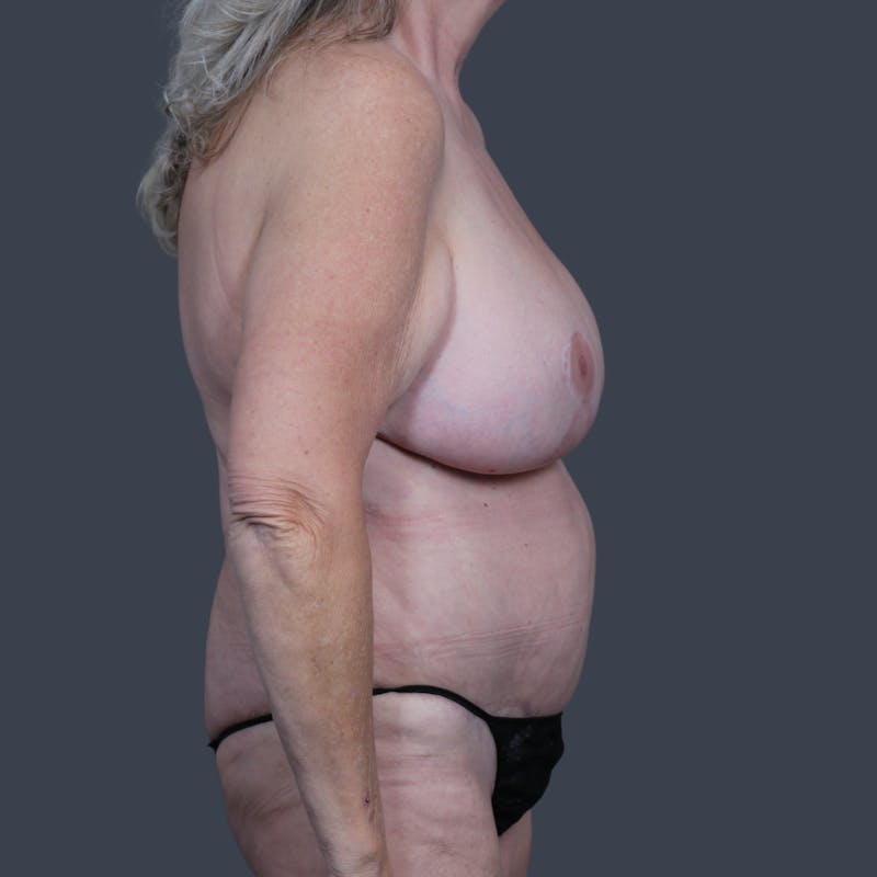 DIEP Flap Before & After Gallery - Patient 269118 - Image 4