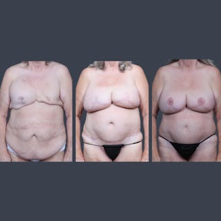 DIEP Flap Before & After Gallery - Patient 269118 - Image 6