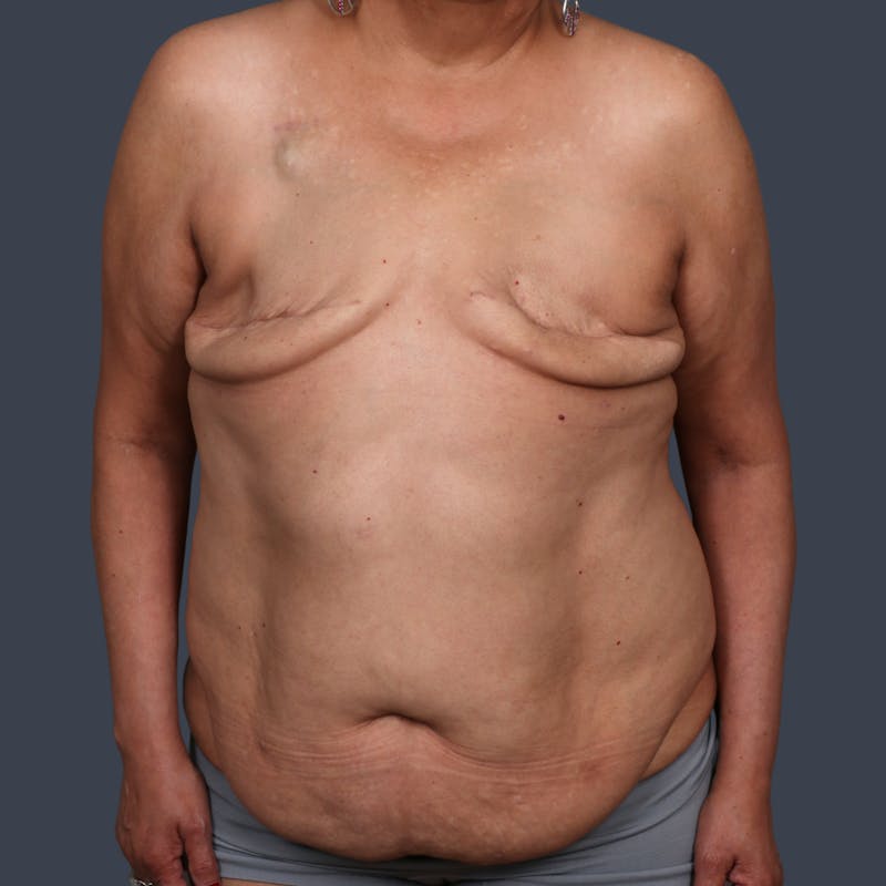 DIEP Flap Before & After Gallery - Patient 405739 - Image 1