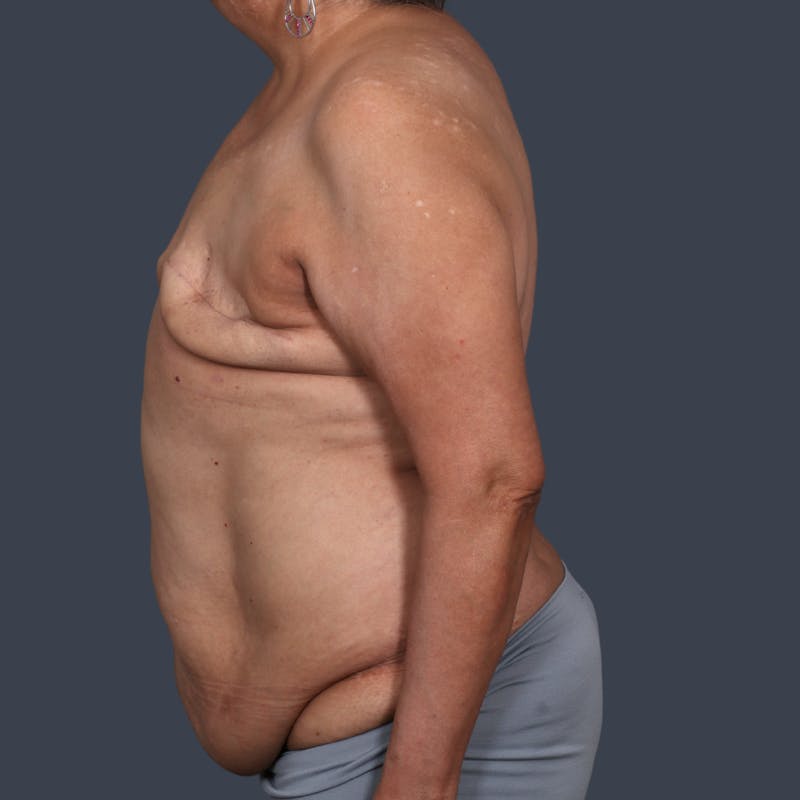 DIEP Flap Before & After Gallery - Patient 405739 - Image 5