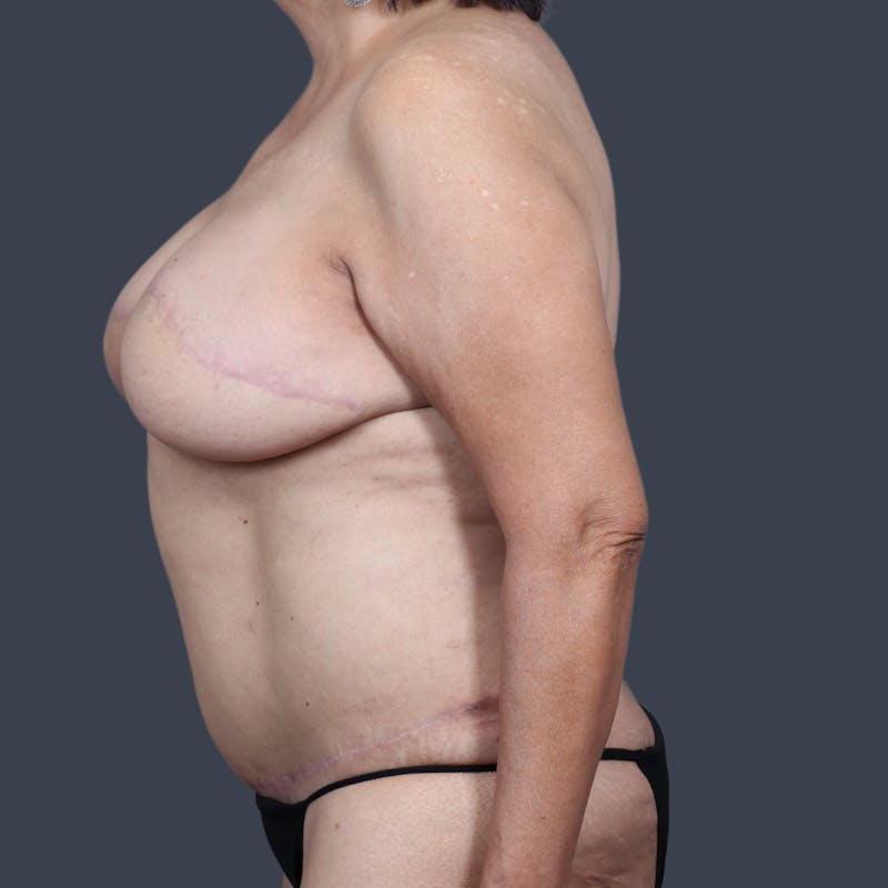 DIEP Flap Before & After Gallery - Patient 405739 - Image 6