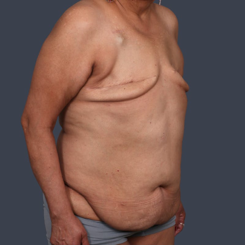 DIEP Flap Before & After Gallery - Patient 405739 - Image 3