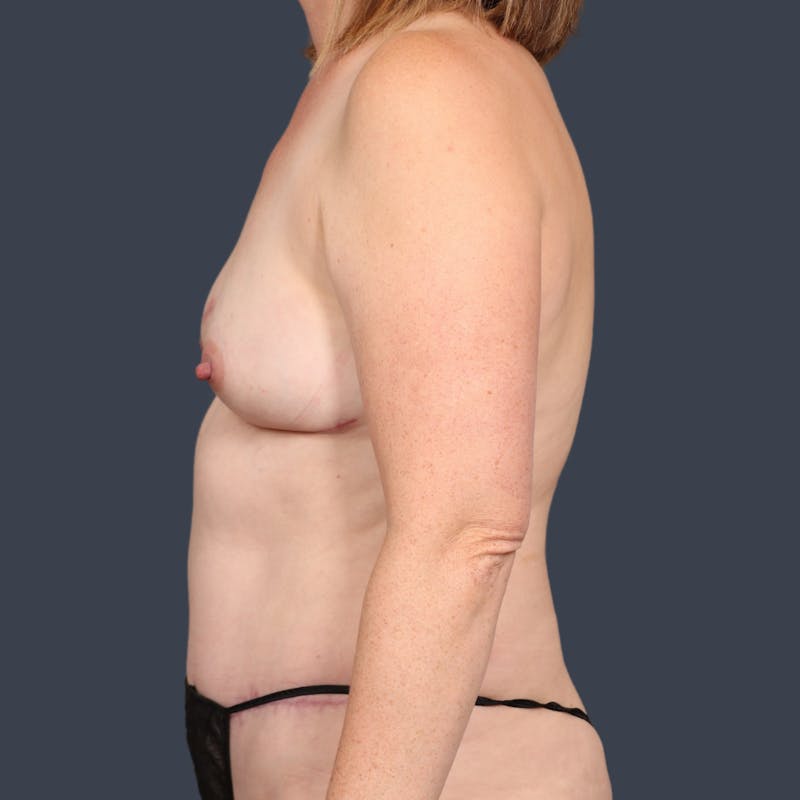 DIEP Flap Before & After Gallery - Patient 288479 - Image 6