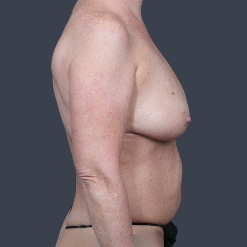 DIEP Flap Before & After Gallery - Patient 170600 - Image 5