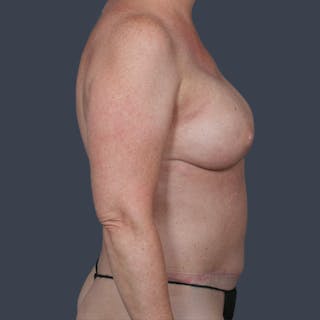DIEP Flap Before & After Gallery - Patient 170600 - Image 6