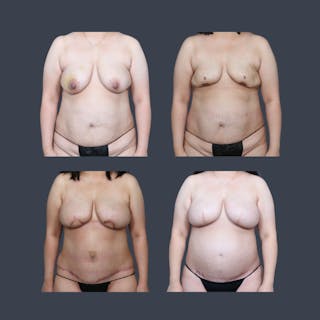 DIEP Flap Before & After Gallery - Patient 363384 - Image 6