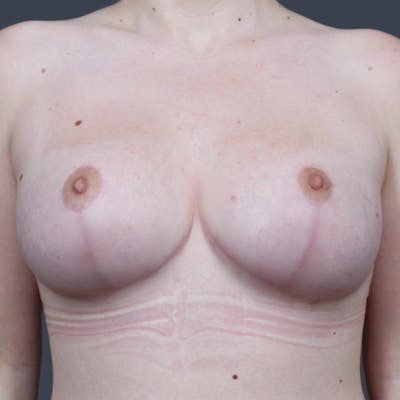 Breast Reduction Before & After Gallery - Patient 118917 - Image 2