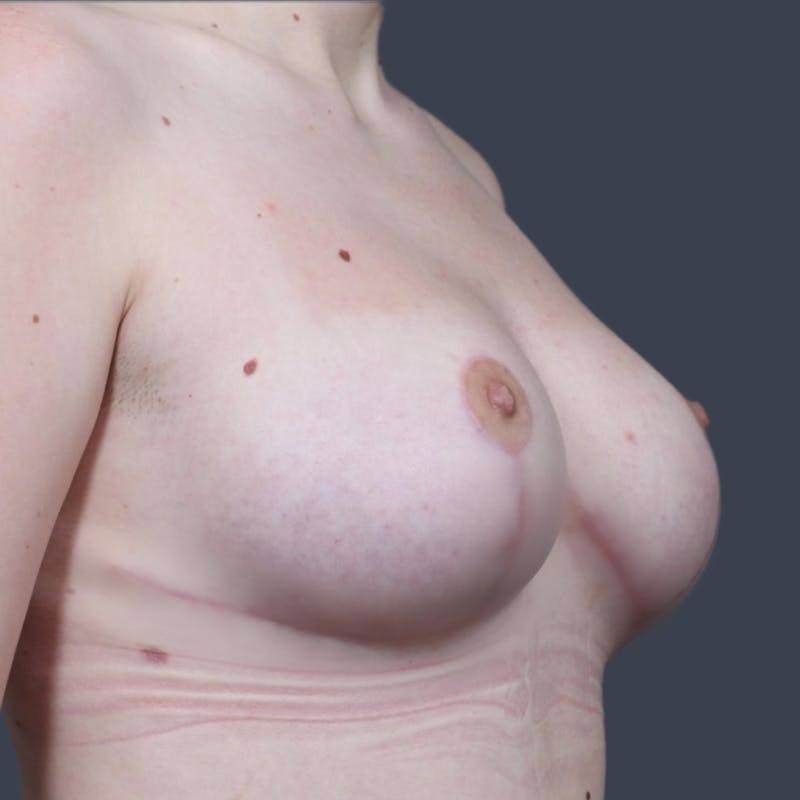 Breast Reduction Before & After Gallery - Patient 118917 - Image 4