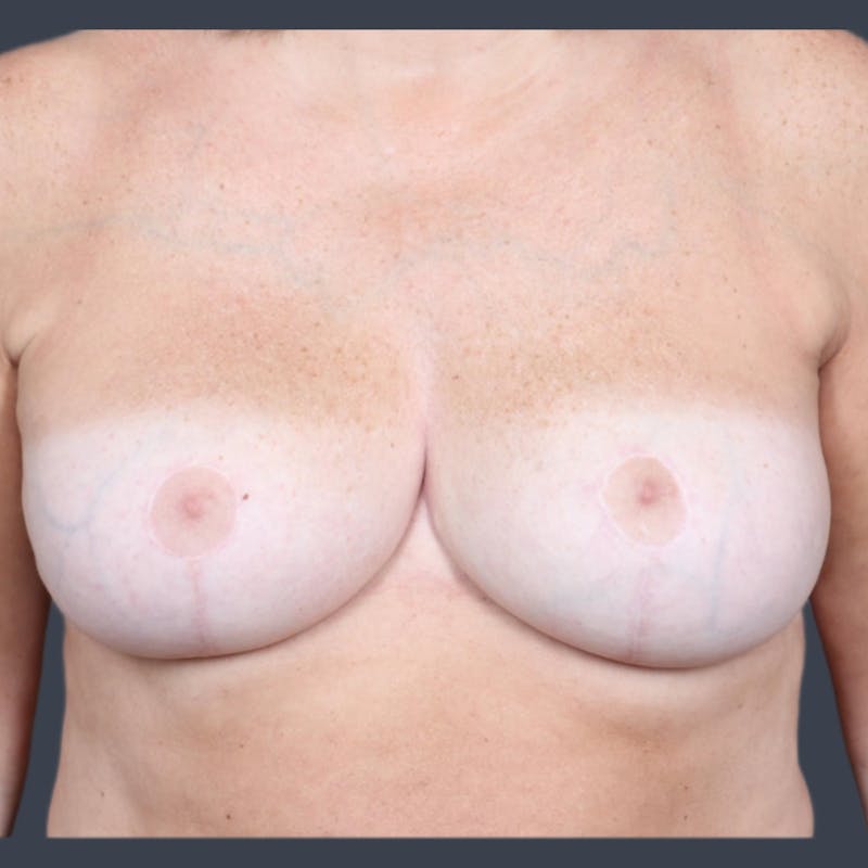 Breast Reduction Before & After Gallery - Patient 231364 - Image 2