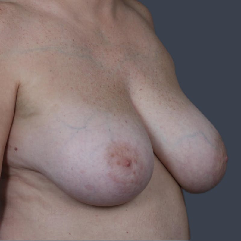 Breast Reduction Before & After Gallery - Patient 231364 - Image 5