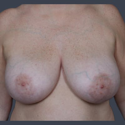 Breast Reduction Before & After Gallery - Patient 231364 - Image 1