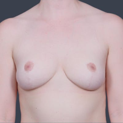 Breast Reduction Before & After Gallery - Patient 119011 - Image 2