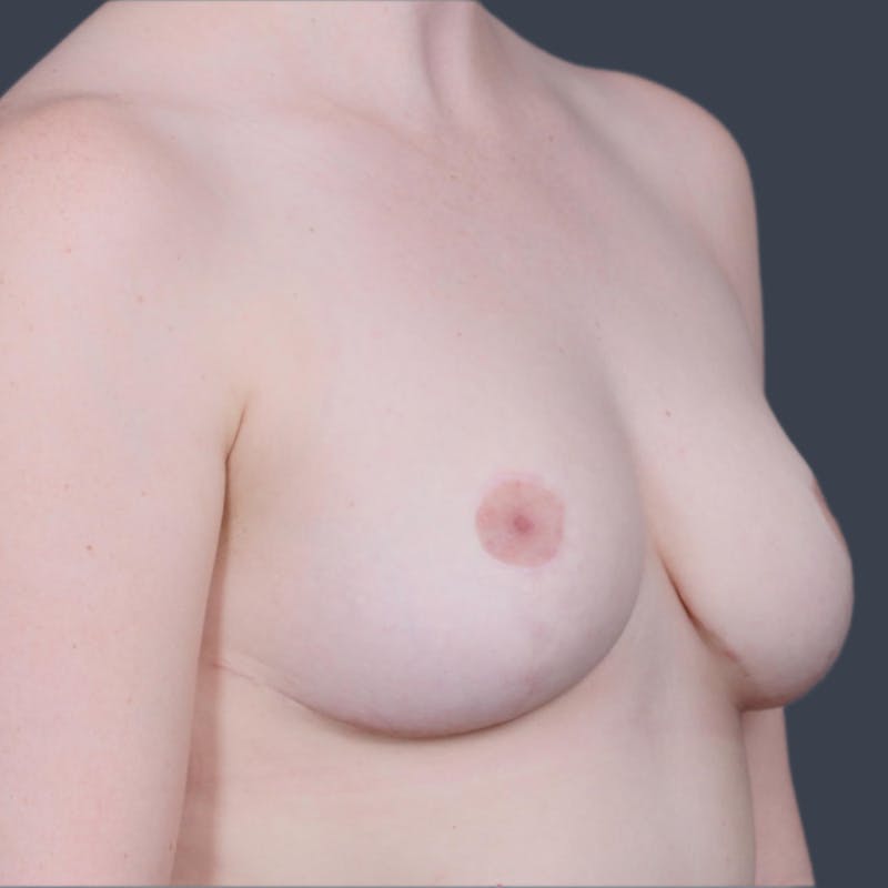 Breast Reduction Before & After Gallery - Patient 119011 - Image 4