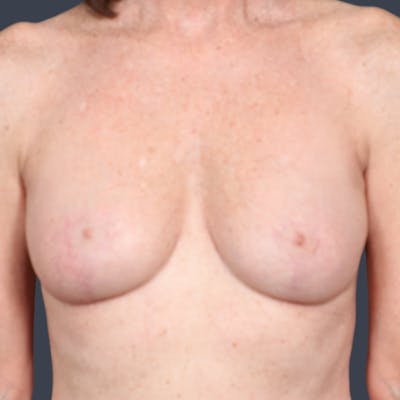 Breast Reduction Before & After Gallery - Patient 209564 - Image 2