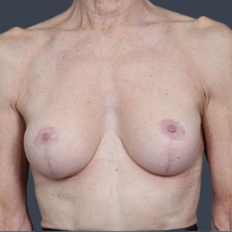 Breast Lift Before & After Gallery - Patient 354373 - Image 2