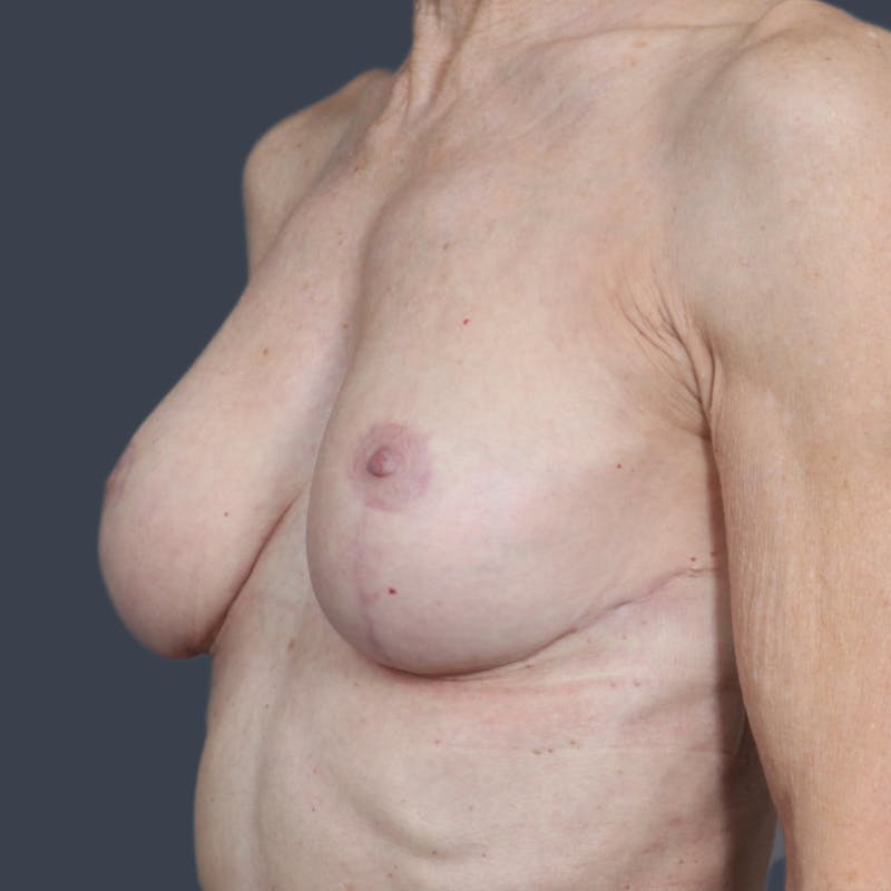Breast Lift Before & After Gallery - Patient 354373 - Image 6