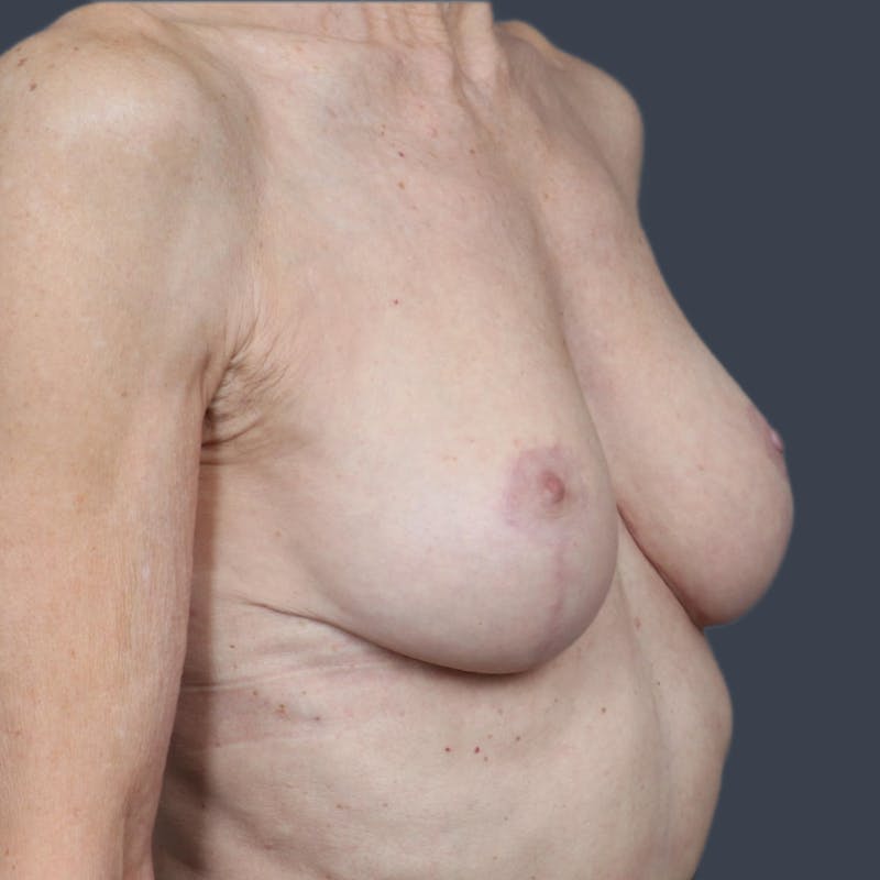 Breast Lift Before & After Gallery - Patient 354373 - Image 4