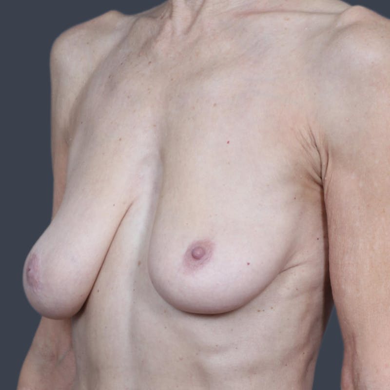 Breast Lift Before & After Gallery - Patient 354373 - Image 5