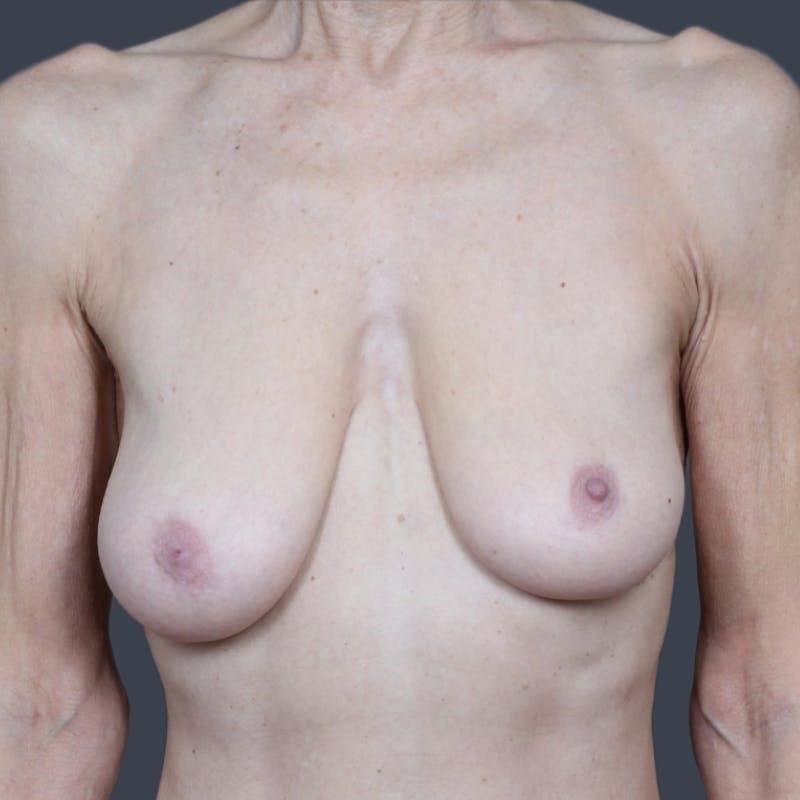 Breast Lift Before & After Gallery - Patient 354373 - Image 1