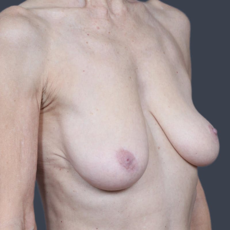 Breast Lift Before & After Gallery - Patient 354373 - Image 3