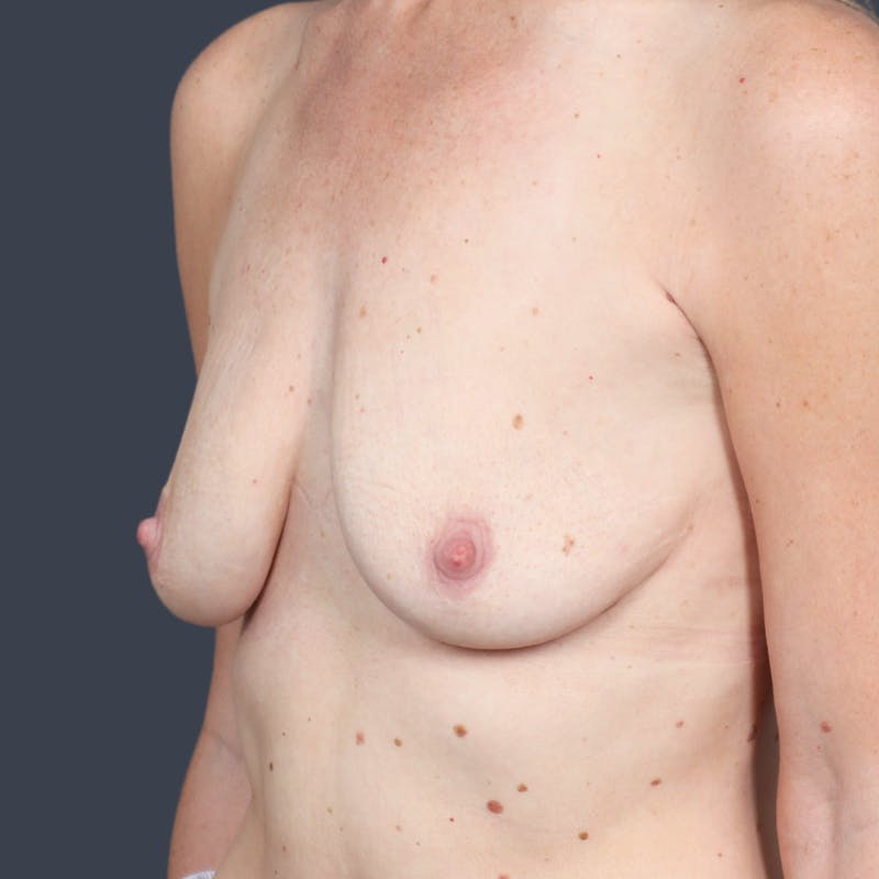 Breast Augmentation Before & After Gallery - Patient 163917 - Image 5
