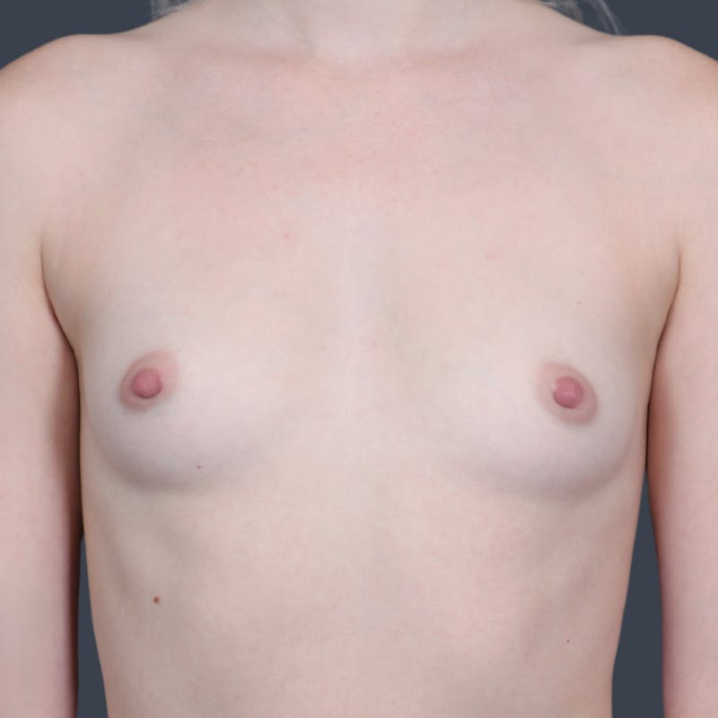 Breast Augmentation Before & After Gallery - Patient 105344 - Image 1