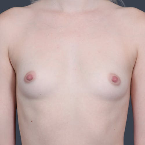 Before procedure image for Breast Augmentation