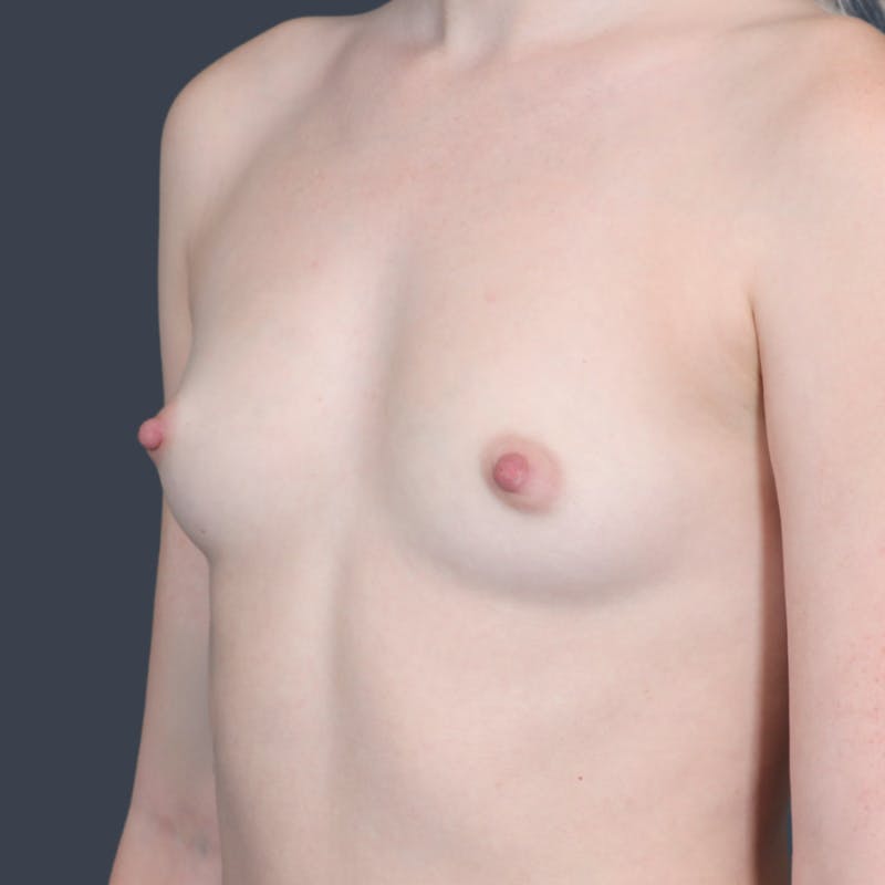 Breast Augmentation Before & After Gallery - Patient 105344 - Image 3