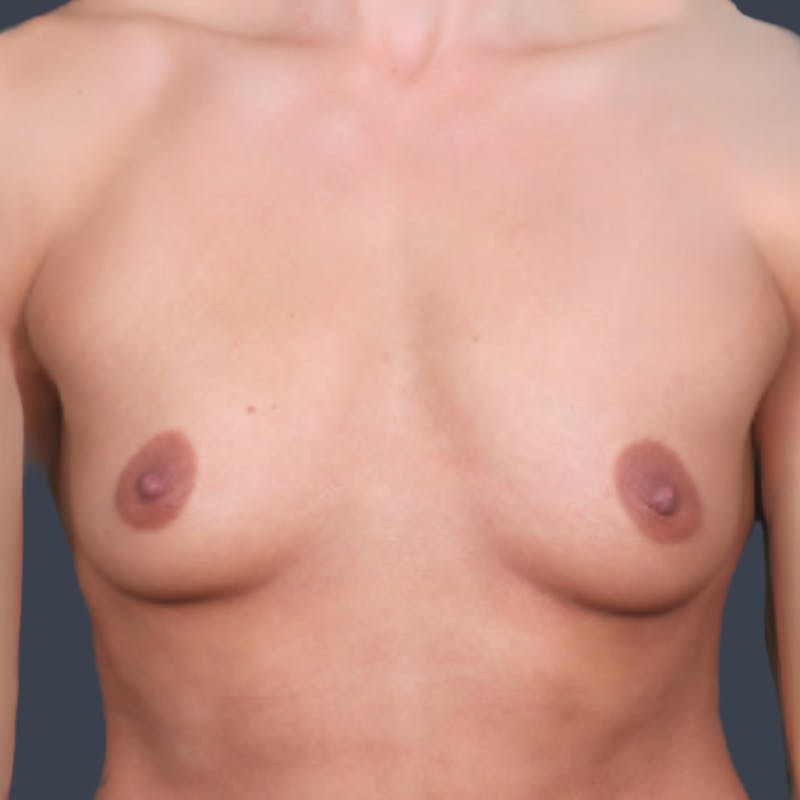 Breast Augmentation Before & After Gallery - Patient 339006 - Image 1