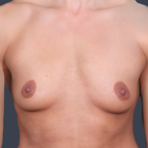 Before procedure image for Breast Augmentation