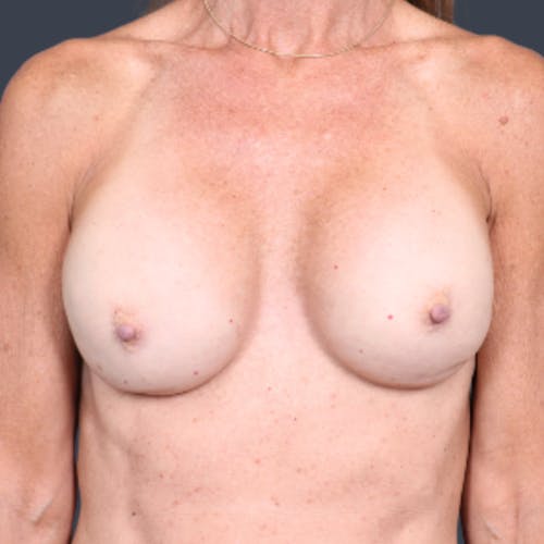 Before procedure image for Implant Exchange