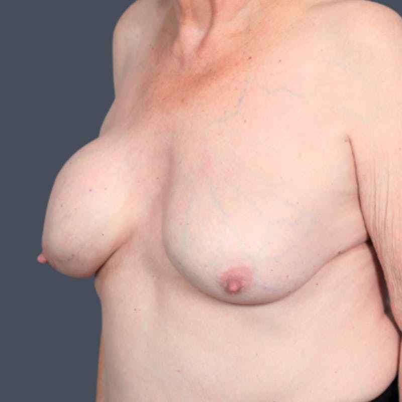 Implant Exchange Before & After Gallery - Patient 402532 - Image 5