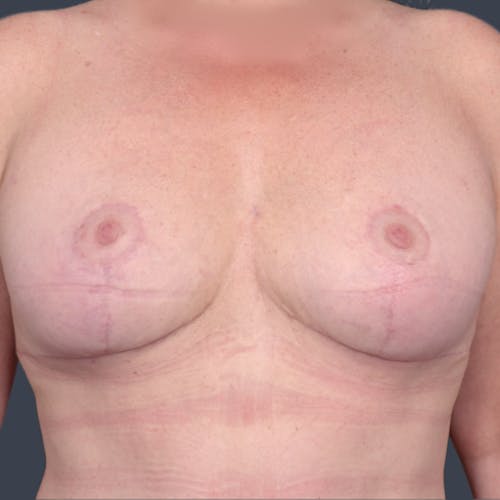 After procedure image for Implant Removal